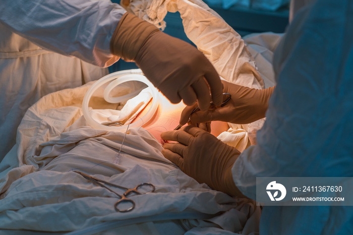 Close up of laparoscopic surgery in a sterile operating room. Percutaneous suturing of the inner ring