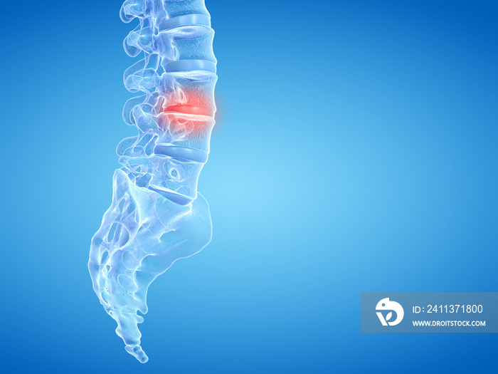 3d rendered medically accurate illustration of painful intervertebral discs