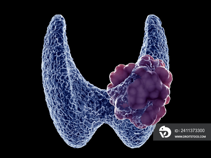 3d rendered medically accurate illustration of a thyroid tumor