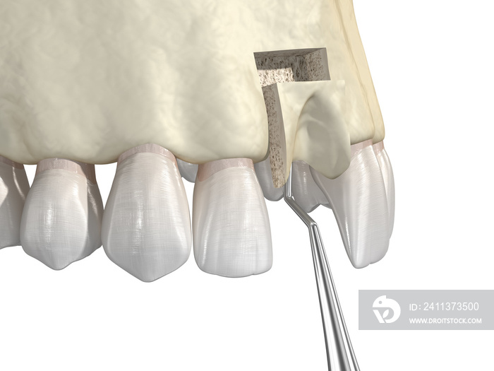 Bone grafting- augmentation using block of bone, tooth implantation. Medically accurate 3D illustration