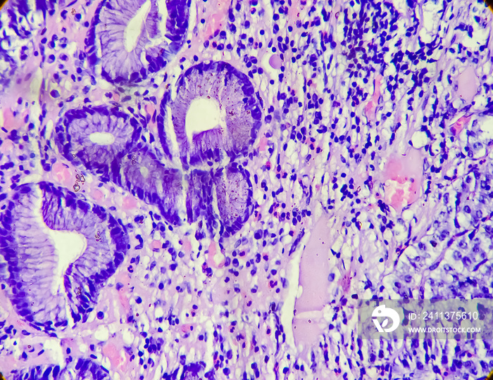 Photomicrograph of a carcinoid tumor, a type of neuroendocrine tumor (NET), which presented as a gastric polyp, 100x view