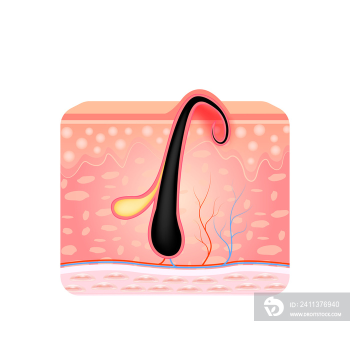 Ingrown hair. Hair has grown back into the skin surface after shaving. Formation of skin acne or pimple. Anatomy infographics of hair and skin. File PNG 3D.