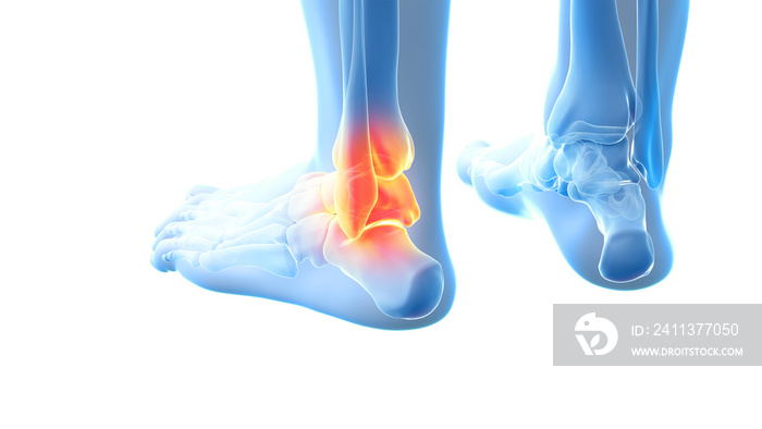 3d rendered illustration of a painful ankle joint