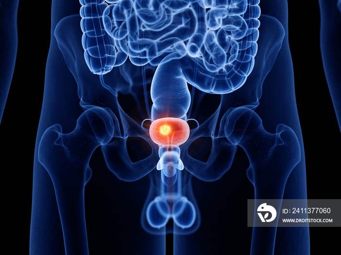 3d rendered medically accurate illustration of bladder cancer