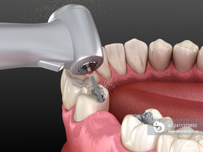 Amalgam removing and preparation for ceramic crown placement. 3D illustration of dental concept