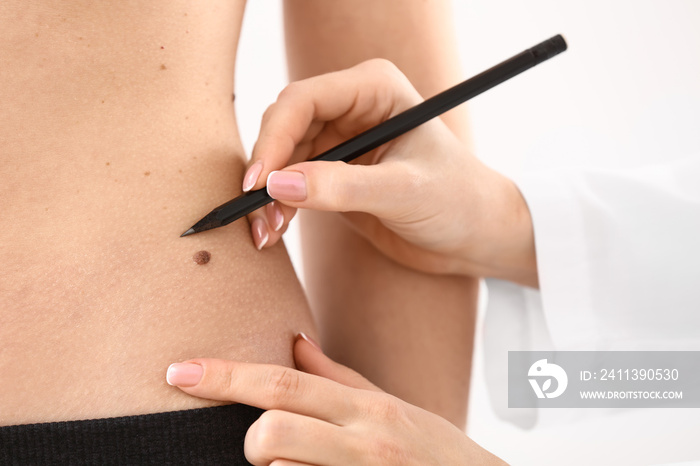 Dermatologist applying marks onto patient’s skin before moles removal, closeup