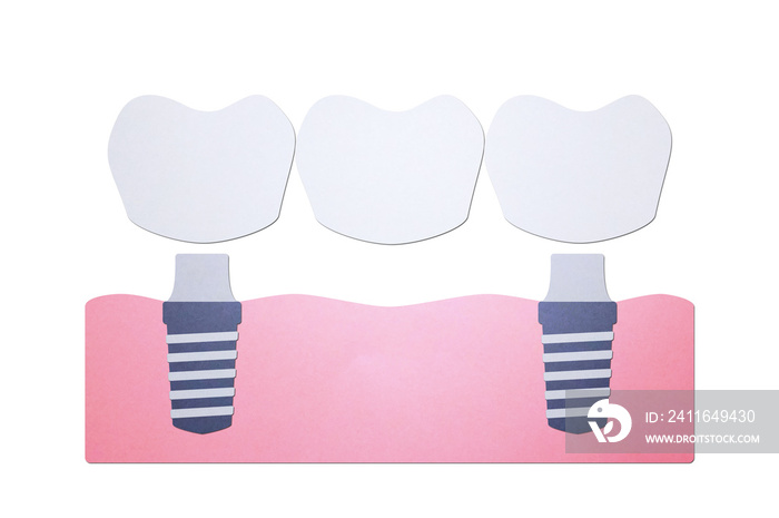 带牙桥的牙齿植入物、安装过程和更换新牙根-牙科卡通纸
