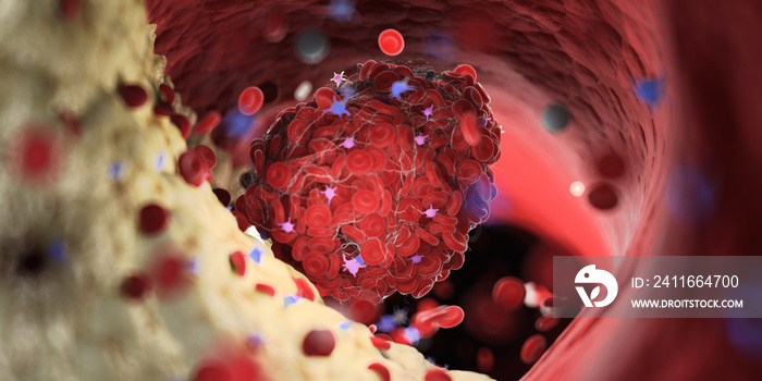 3d rendered medically accurate illustration of a thrombus emerging from a capped plaque