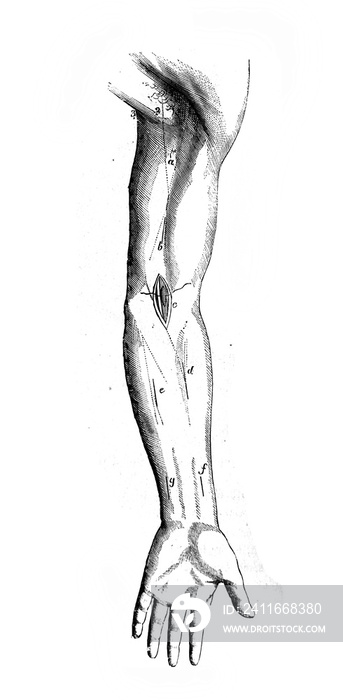 手臂折痕处的肱骨结扎术，见B.Anger的旧书《DAnatomie Chirurgicale》，1869年，巴黎。