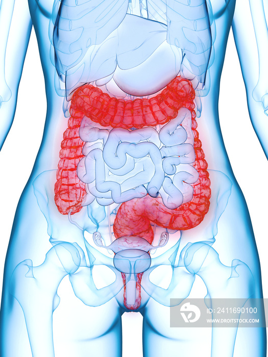 3d rendered medically accurate illustration of a diseased colon