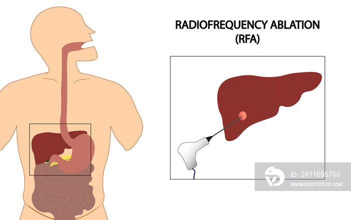 肝脏射频消融（RFA）插图。肝癌消融。针刀消融