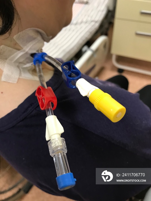 Central venous catheter