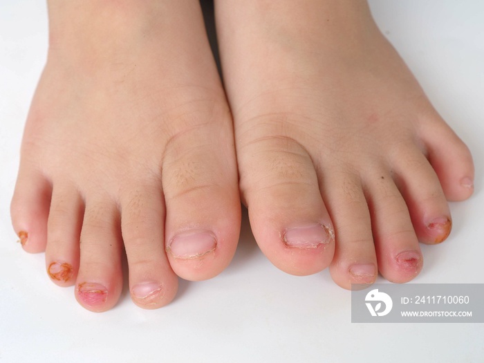 Child foot and ingrown nail, onychocryptosis. closeup photo, blurred.