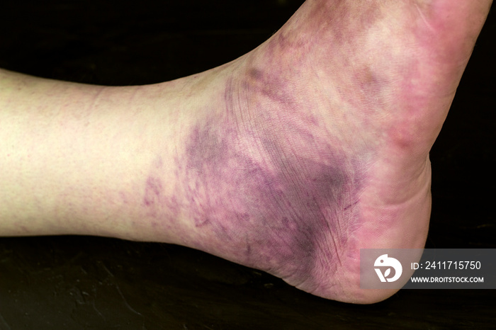 Broken human ankle. Huge purple bruise on a man’s leg