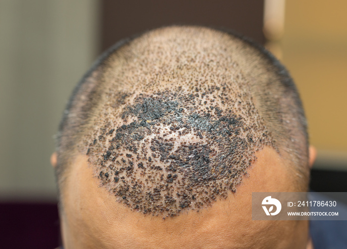 Top view of a man’s head with hair transplant surgery. Bald head of hair loss treatment