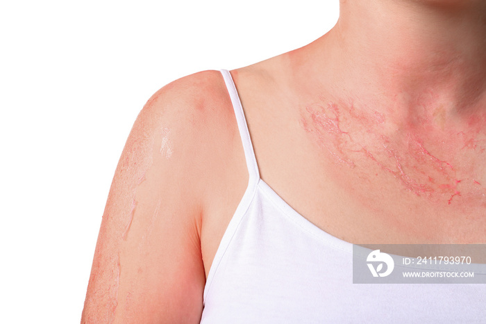 Woman with red sunburned skin against white background, closeup