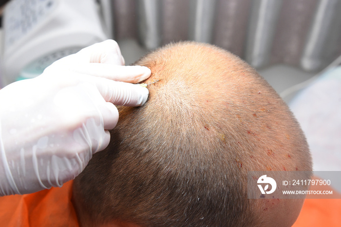 Treatment of baldness with beauty injections. Mesotherapy. Plasmalifting.