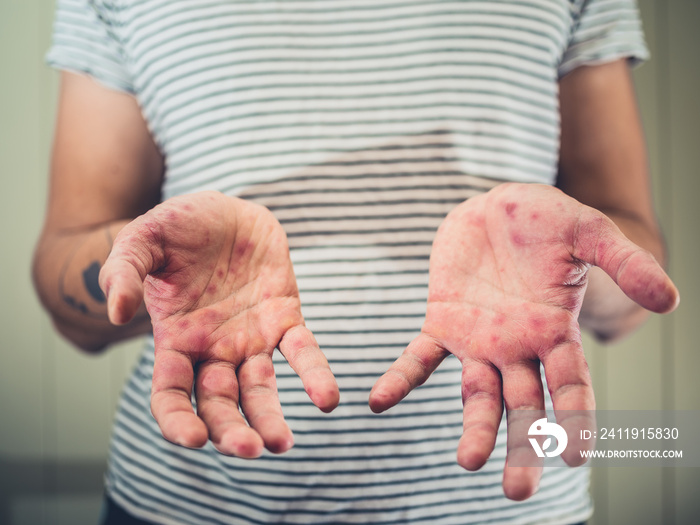 Young man with hand foot and mouth disease