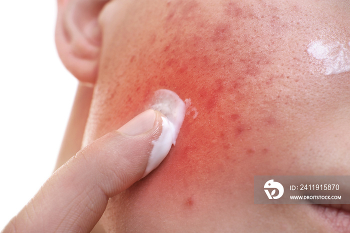 Skin care concept. Young man applying acne treatment cream, closeup