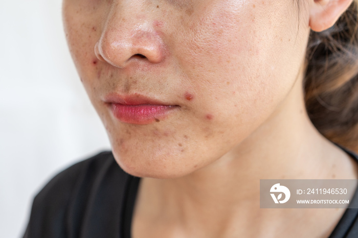 Cropped shot of woman having problems of acne inflamed on her face. Inflamed acne consists of swelli