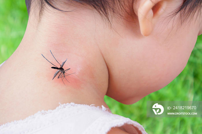 可爱的亚洲女婴颈部皮肤因蚊虫叮咬和pl时吸血而出现皮疹和过敏