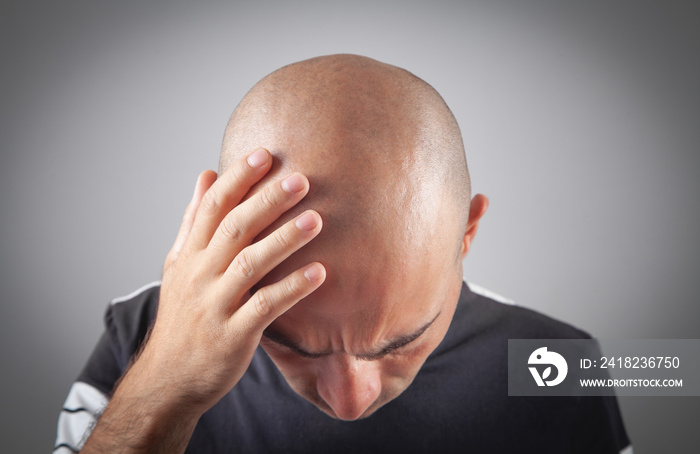 Caucasian bald man. Before hair transplantation