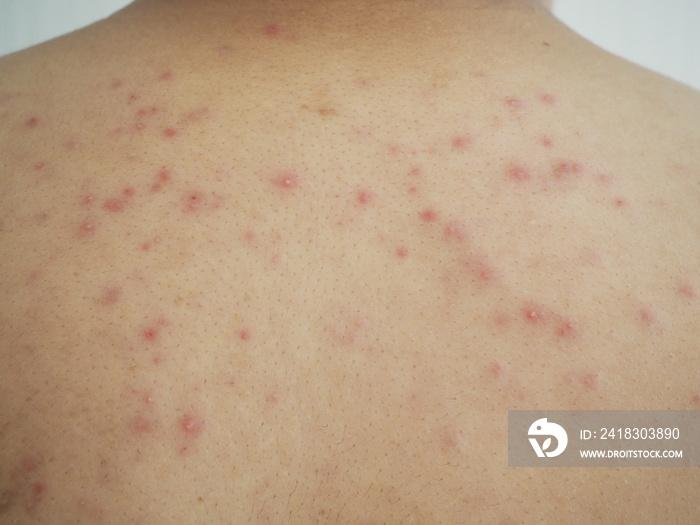 heat rash or prickly heat or miliaria on the back skin asian man cause of outdoor work in the sunny 