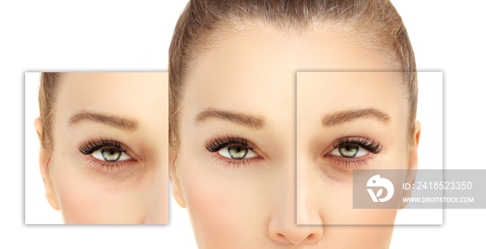 Lower Eyelid Blepharoplasty.