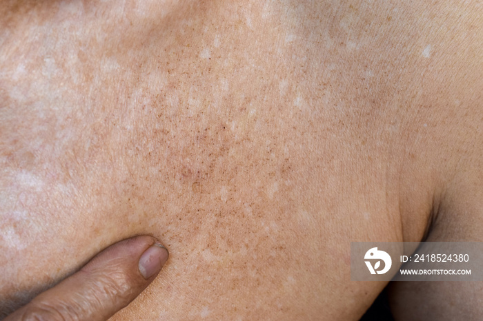 Age spots on body. They are brown, gray, or black spots and also called liver spots, senile lentigo,