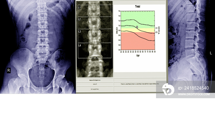 X光检查腰骶脊柱和骨盆以及脊柱炎症和骨密度测量脊柱保健