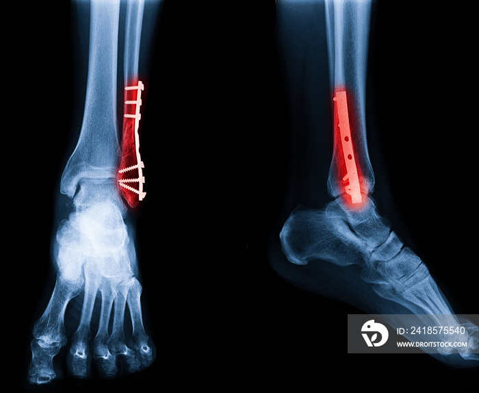 X-ray image of ankle fracture , broken ankle , pott fracture fix by open surgery and metal plate and