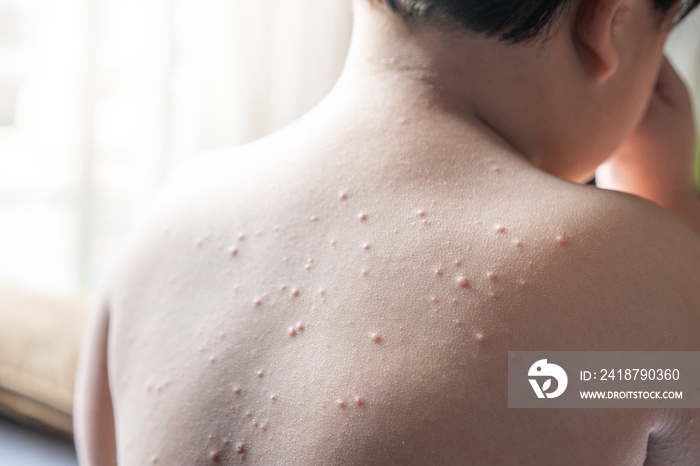 The boy had chickenpox. He itches and had the whole body, especially his back.