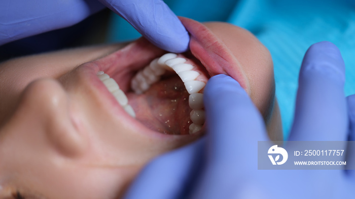 Doctor dentist examining patient oral cavity with veneers closeup