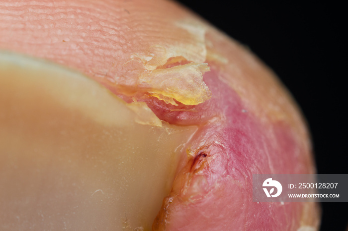 macro photo of an ingrown fingernail in the healing period