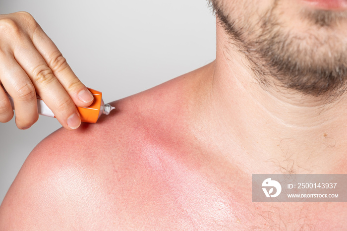 Applying therapeutic ointment to the skin of a person with a sunburn, close-up.