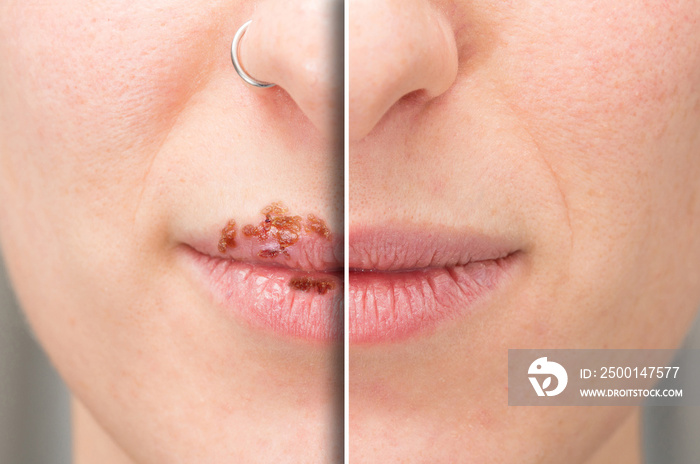 Macro of a woman’s lips before and after herpes treatment