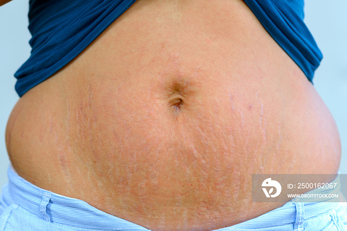 Woman displaying stretch marks after pregnancy