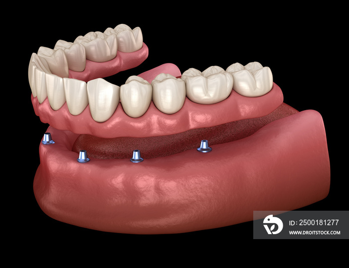 Mandibular prosthesis All on 6 system supported by implants. Medically accurate 3D illustration of human teeth and dentures concept