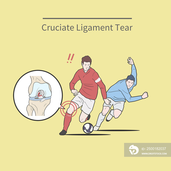 Cartoon medical illustration for explaining anterior cruciate ligament rupture