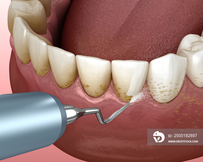 Oral hygiene: Scaling and root planing (conventional periodontal therapy). Medically accurate 3D illustration of human teeth treatment