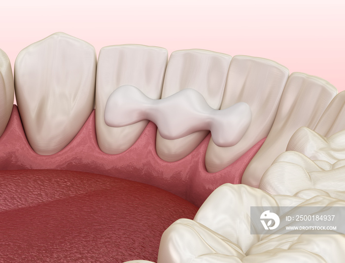 Maryland bridge made from ceramic, frontal tooth recovery. Medically accurate 3D illustration of dental concept