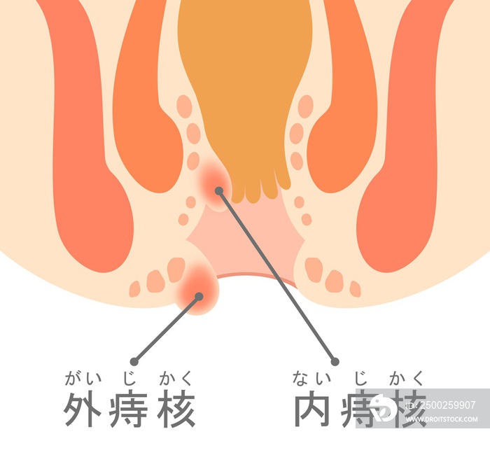 いぼ痔