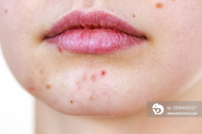 Female face with acne skin problem