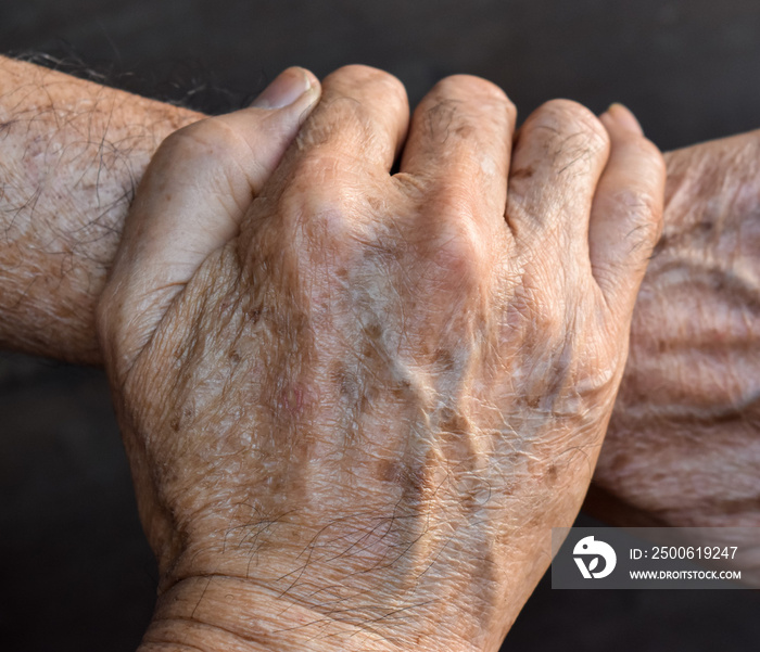 Age spots on hands. They are brown, gray, or black spots and also called liver spots, senile lentigo