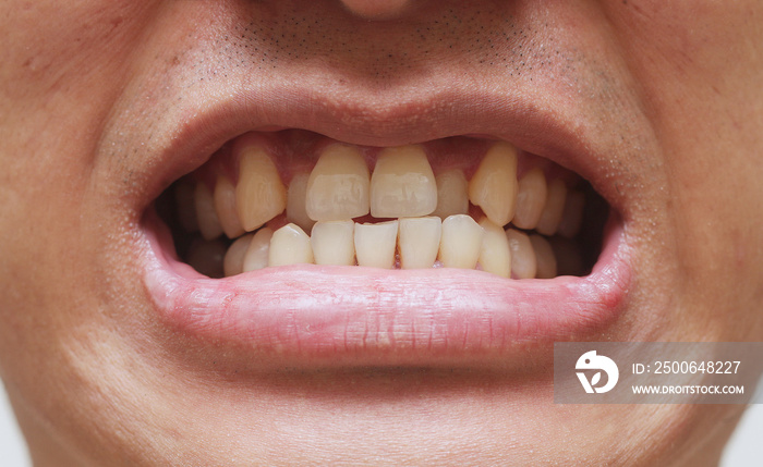 Stacked or overlapping teeth and yellow stain. Also called crowded teeth.