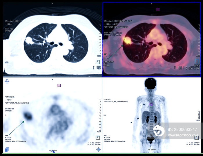 PET CT Scan fusion image