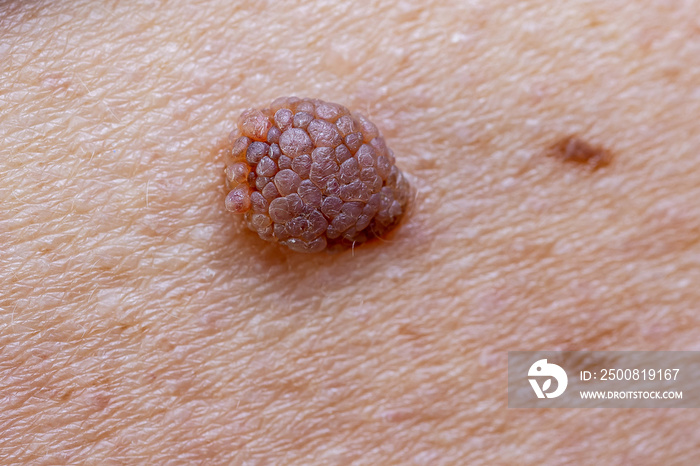 Oncology mole big wart on skin old woman. Concept dermatology body diseases malignant tumor