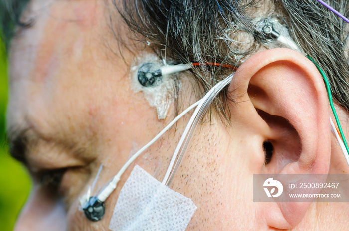 A middle aged man wears polysomnography electrodes to measure brain activity, breathing and movement during sleep.