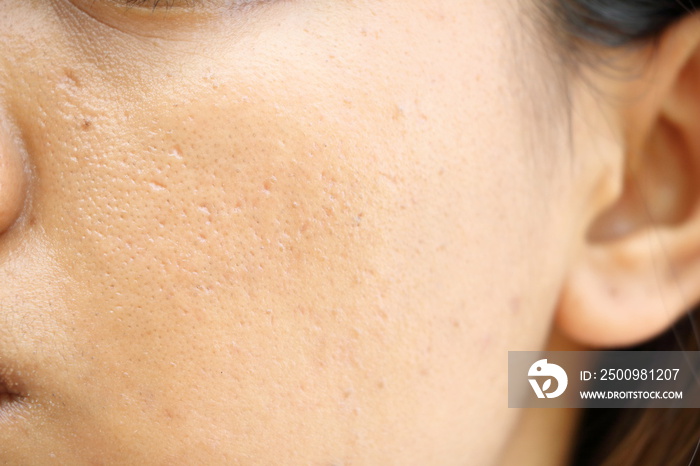 close up wide pores on oily face skin of asia woman