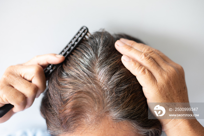 Closeup Hair grows on the head of an old woman